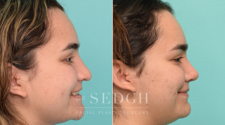 patient before and after rhinoplasty procedure