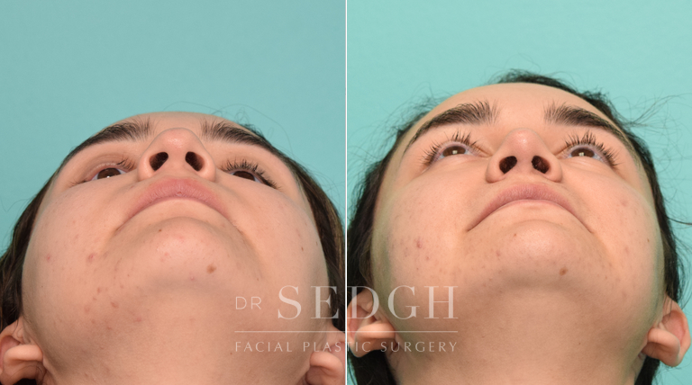 patient before and after rhinoplasty procedure