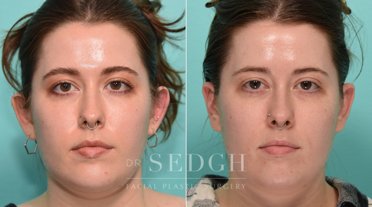 patient before and after otoplasty procedure