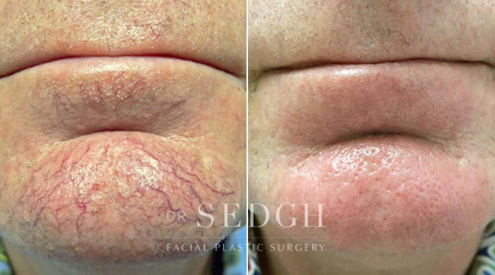 Client before and after hyperpigmentation treatment