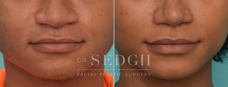 Lip Lift Before and After | Sedgh