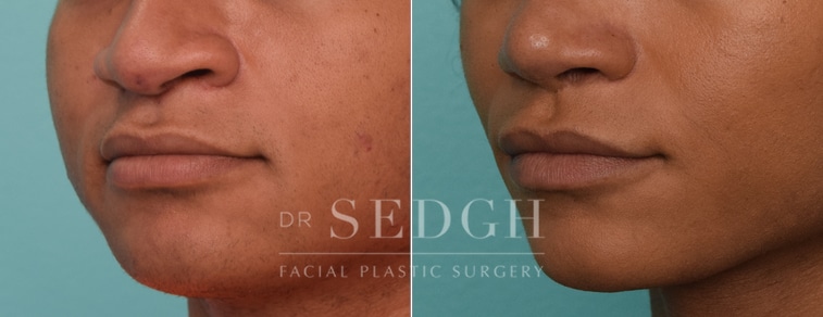 Lip Lift Before and After | Sedgh