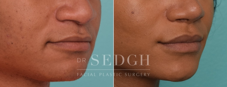 Lip Lift Before and After | Sedgh
