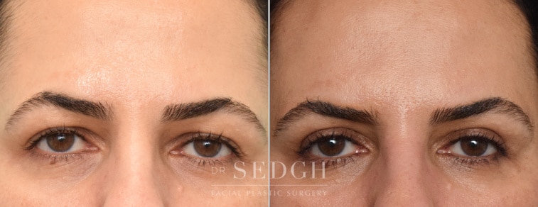 female patient before and after brow lift procedure