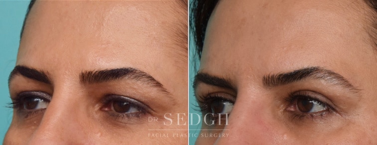 female patient before and after brow lift procedure