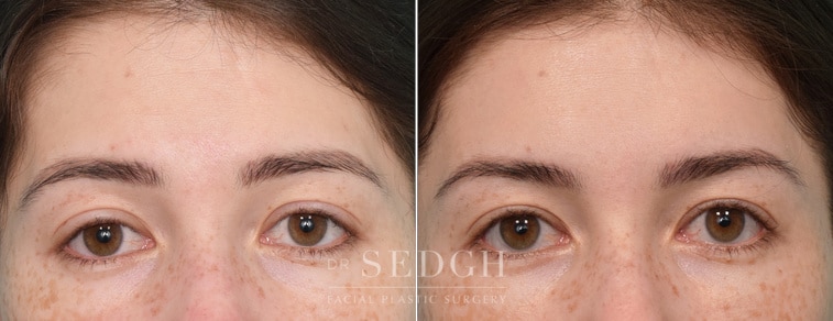 male patient before and after brow lift procedure
