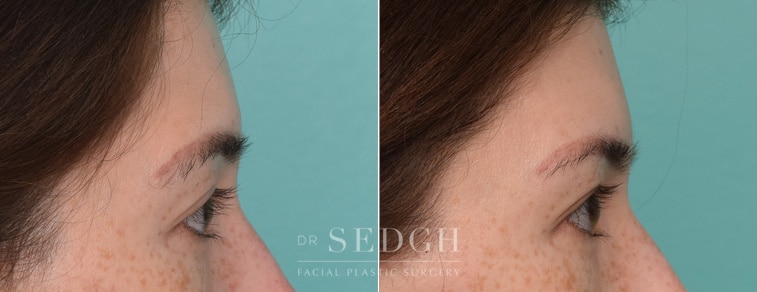 female patient before and after brow lift procedure