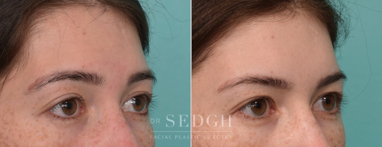 female patient before and after brow lift procedure