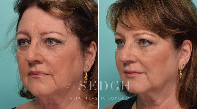 Female Patient Before and After Filler & Botox | Sedgh
