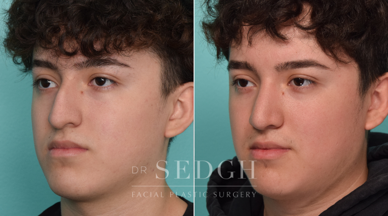 Male Patient Before and After Rhinoplasty | Sedgh