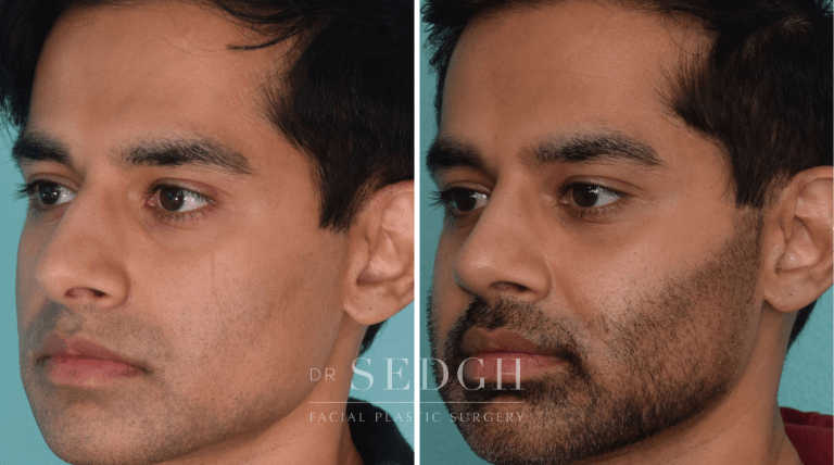 Male Rhinoplasty Before & After Photos | Dr. Sedgh
