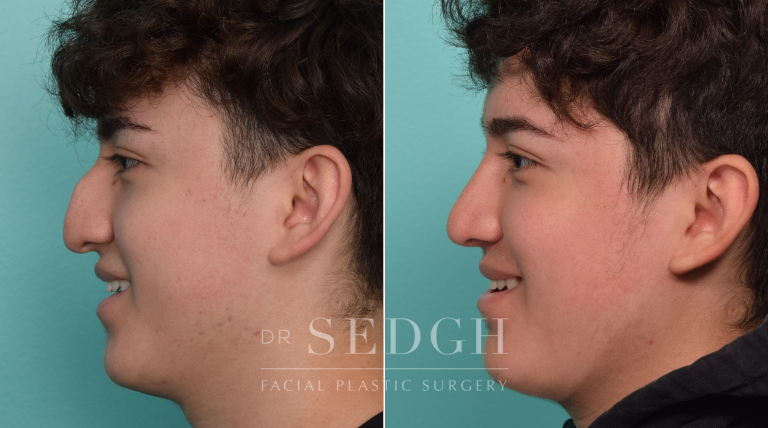 Male Patient Before and After Rhinoplasty | Sedgh