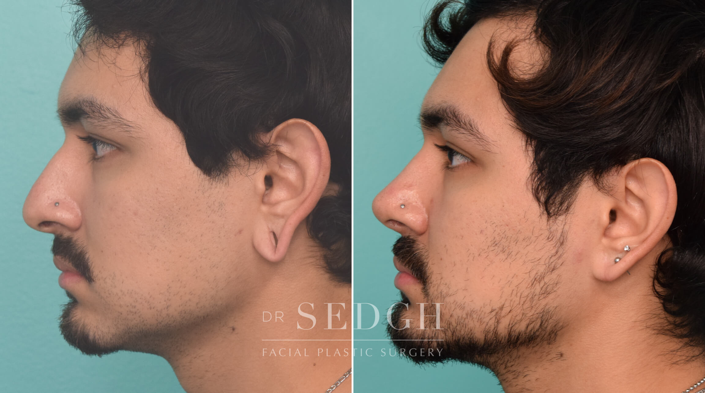 Male Rhinoplasty Before & After Photos | Dr. Sedgh