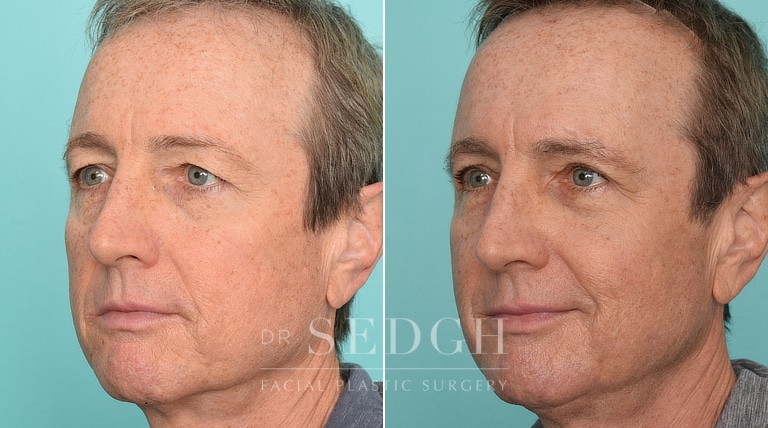 Male Patient Before and After Brow Lift | Sedgh