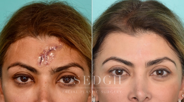 female patient before and after scar revision procedure