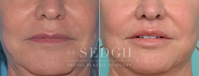 patient before and after lip lift procedure