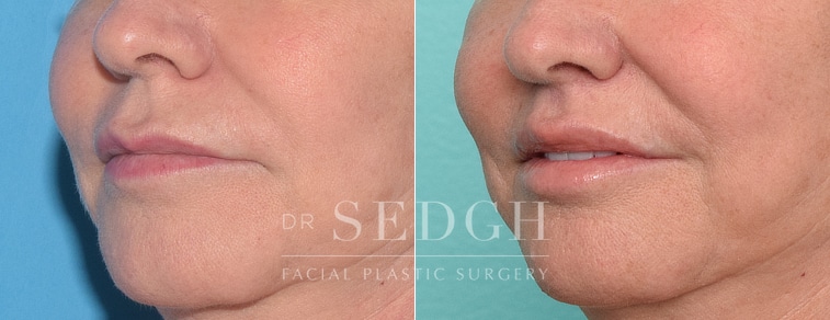 patient before and after lip lift procedure