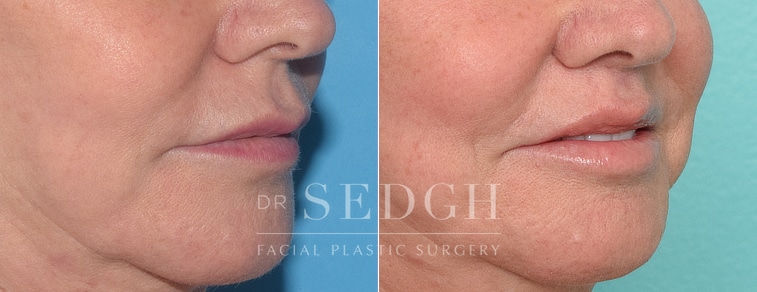 patient before and after lip lift procedure
