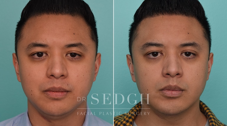 patient before and after chin augmentation and neck lipo procedure