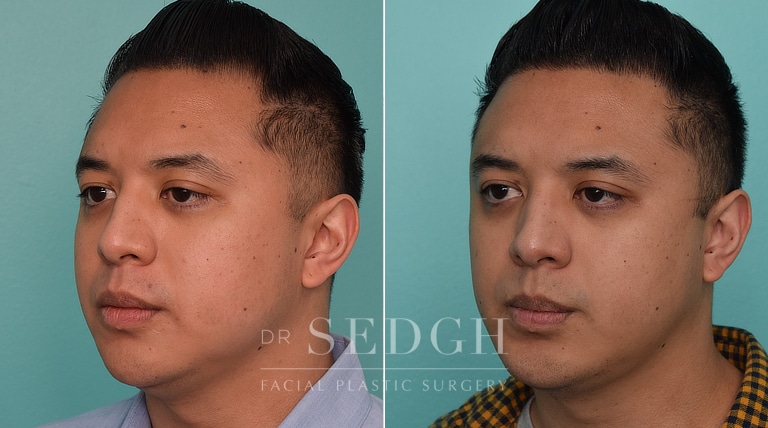 patient before and after chin augmentation and neck lipo procedure