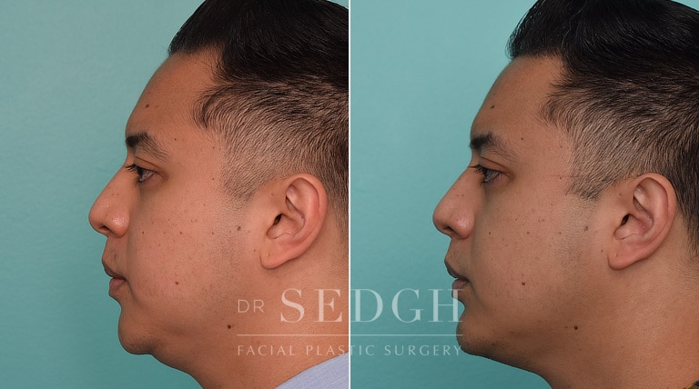 patient before and after chin augmentation and neck lipo procedure