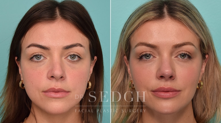 patient before and after revision rhinoplasty and buccal fat reduction procedure