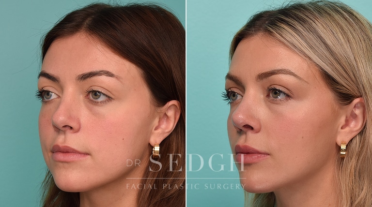 patient before and after revision rhinoplasty and buccal fat reduction procedure