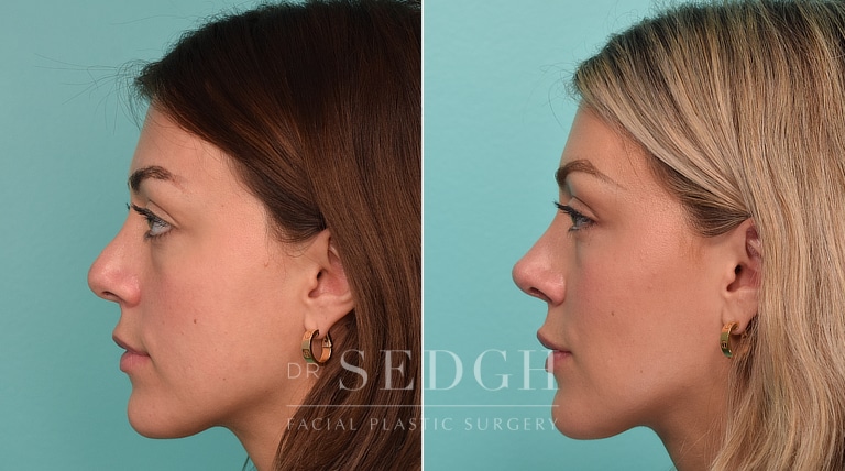 patient before and after revision rhinoplasty and buccal fat reduction procedure