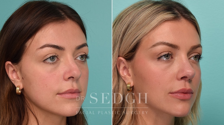 patient before and after revision rhinoplasty and buccal fat reduction procedure