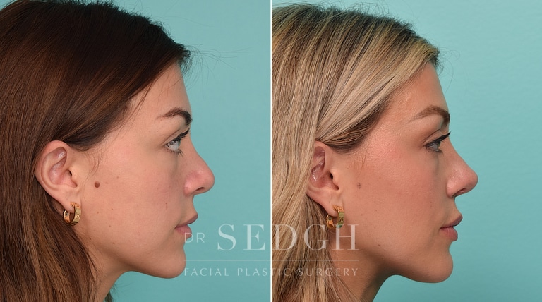 patient before and after revision rhinoplasty and buccal fat reduction procedure