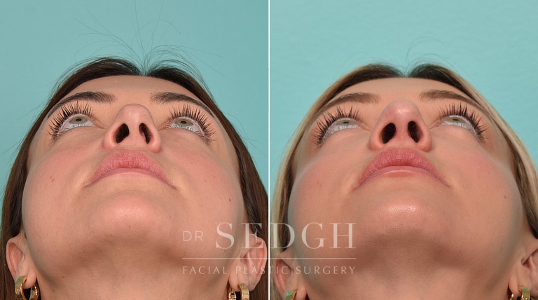patient before and after revision rhinoplasty and buccal fat reduction procedure