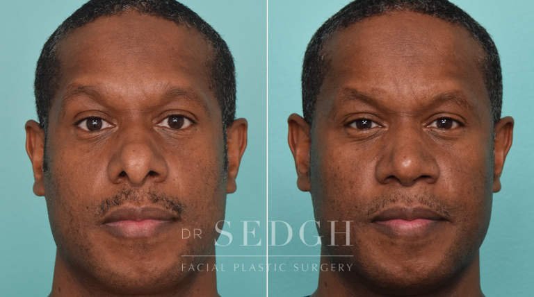 patient before and after rhinoplasty procedure