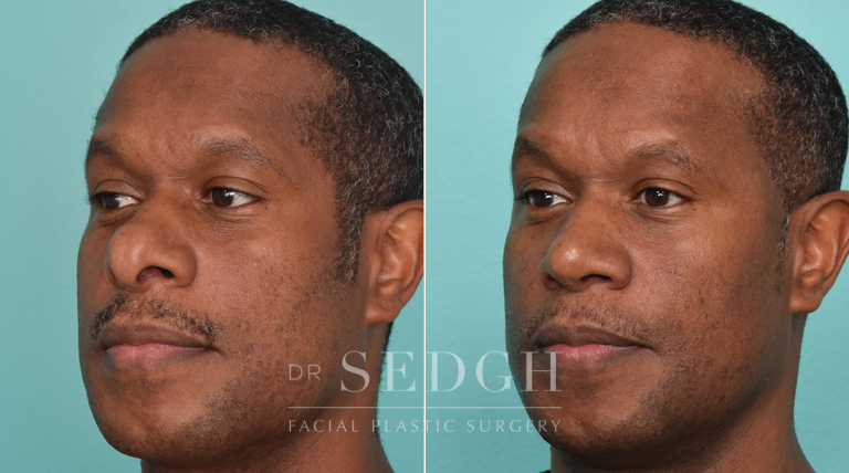 patient before and after rhinoplasty procedure