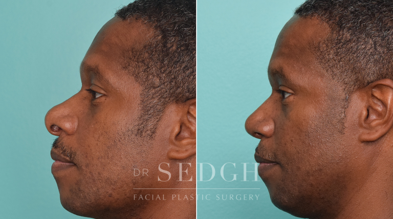 patient before and after rhinoplasty procedure