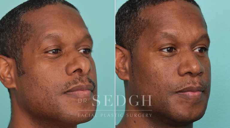 patient before and after rhinoplasty procedure