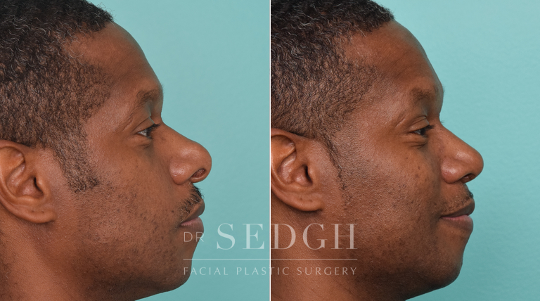 patient before and after rhinoplasty procedure