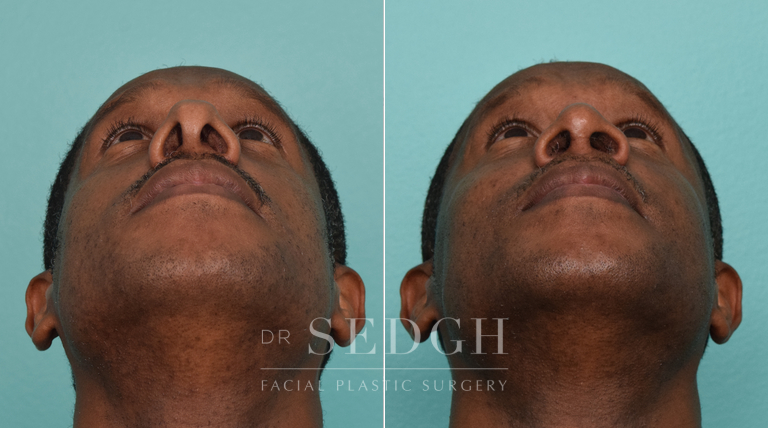 patient before and after rhinoplasty procedure