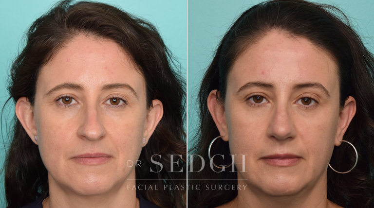 patient before and after rhinoplasty procedure