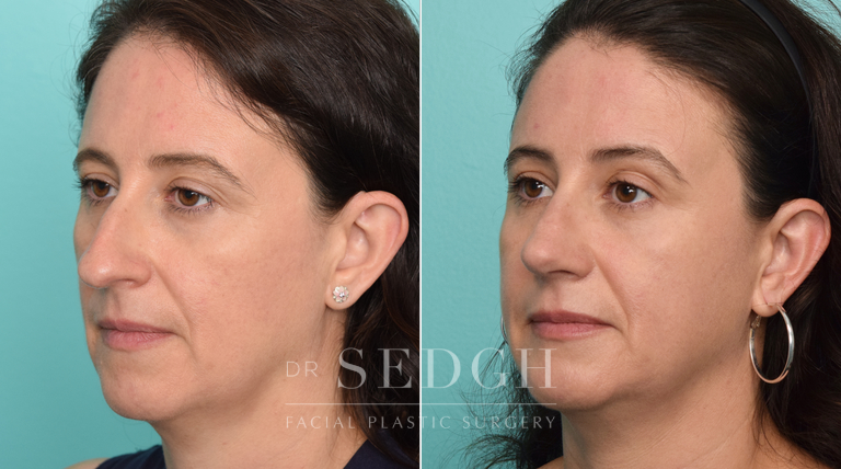 patient before and after rhinoplasty procedure