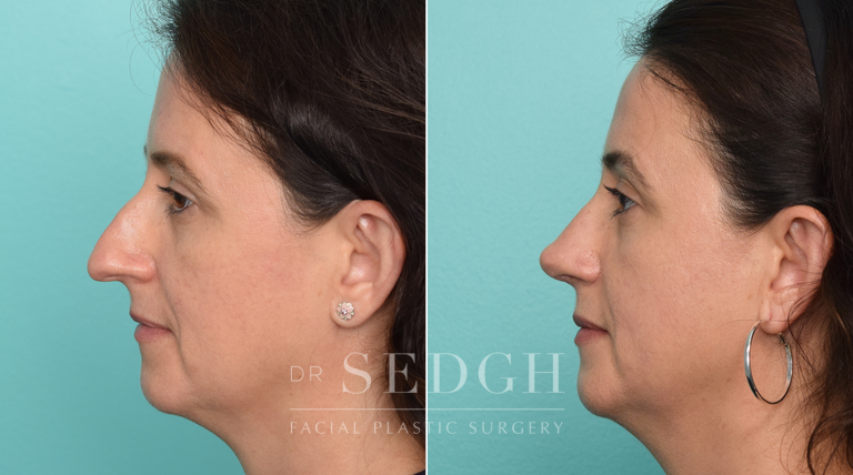 patient before and after rhinoplasty procedure