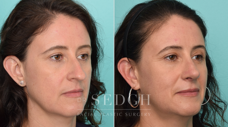 patient before and after rhinoplasty procedure