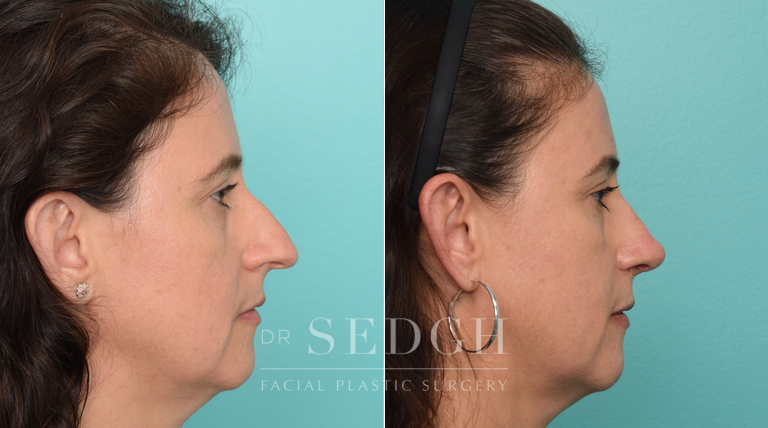 patient before and after rhinoplasty procedure