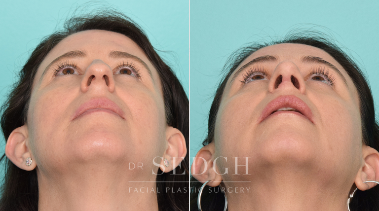 patient before and after rhinoplasty procedure