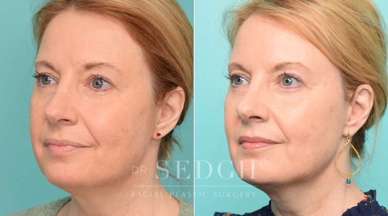 patient before and after chin augmentation