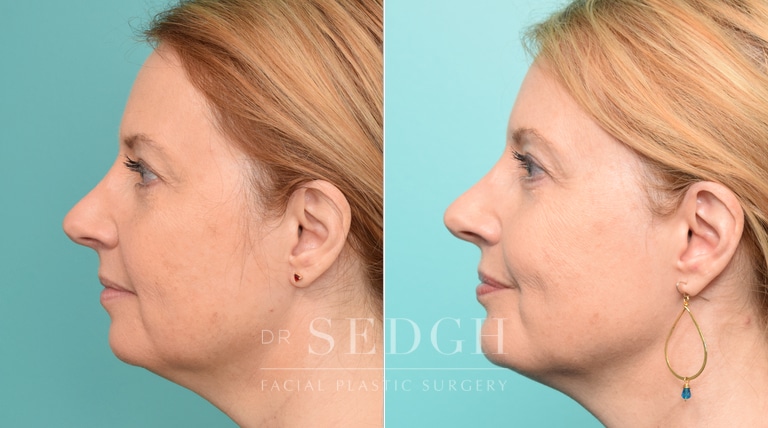 patient before and after chin augmentation