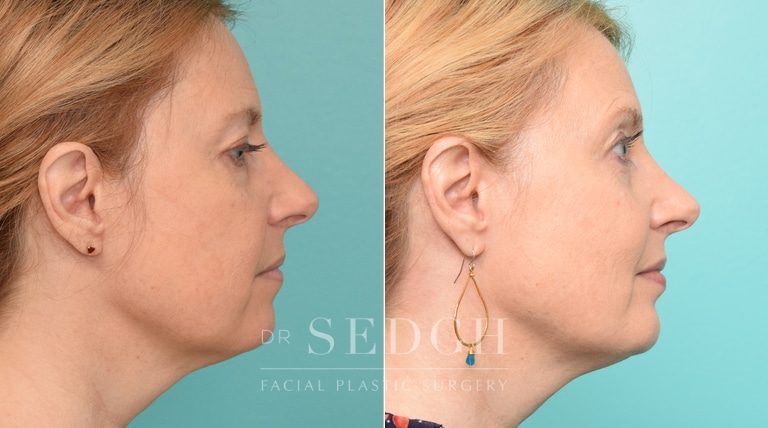 patient before and after chin augmentation