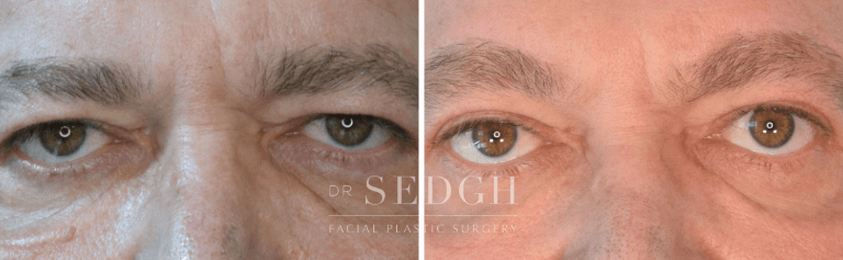 Brow Lift Before and After