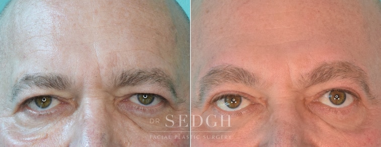 male patient before and after brow lift procedure