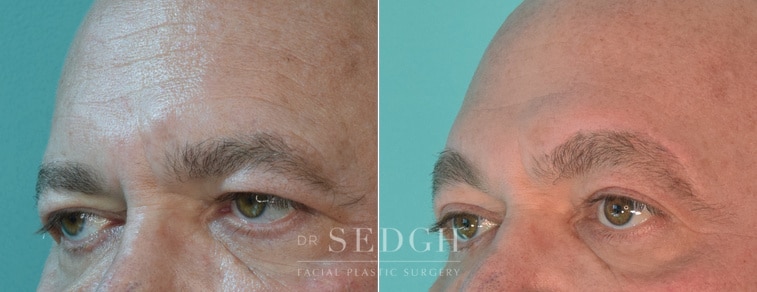 male patient before and after brow lift procedure