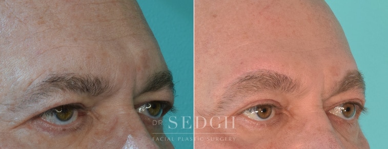 male patient before and after brow lift procedure